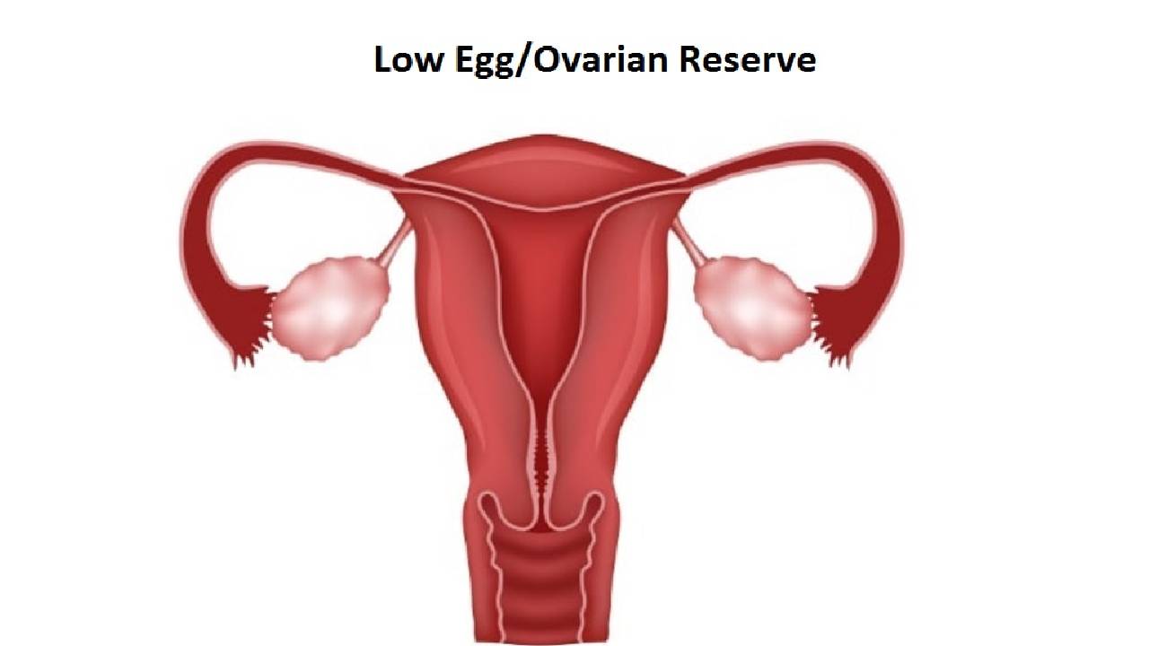 Understanding the causes and treatment of diminished ovarian reserve